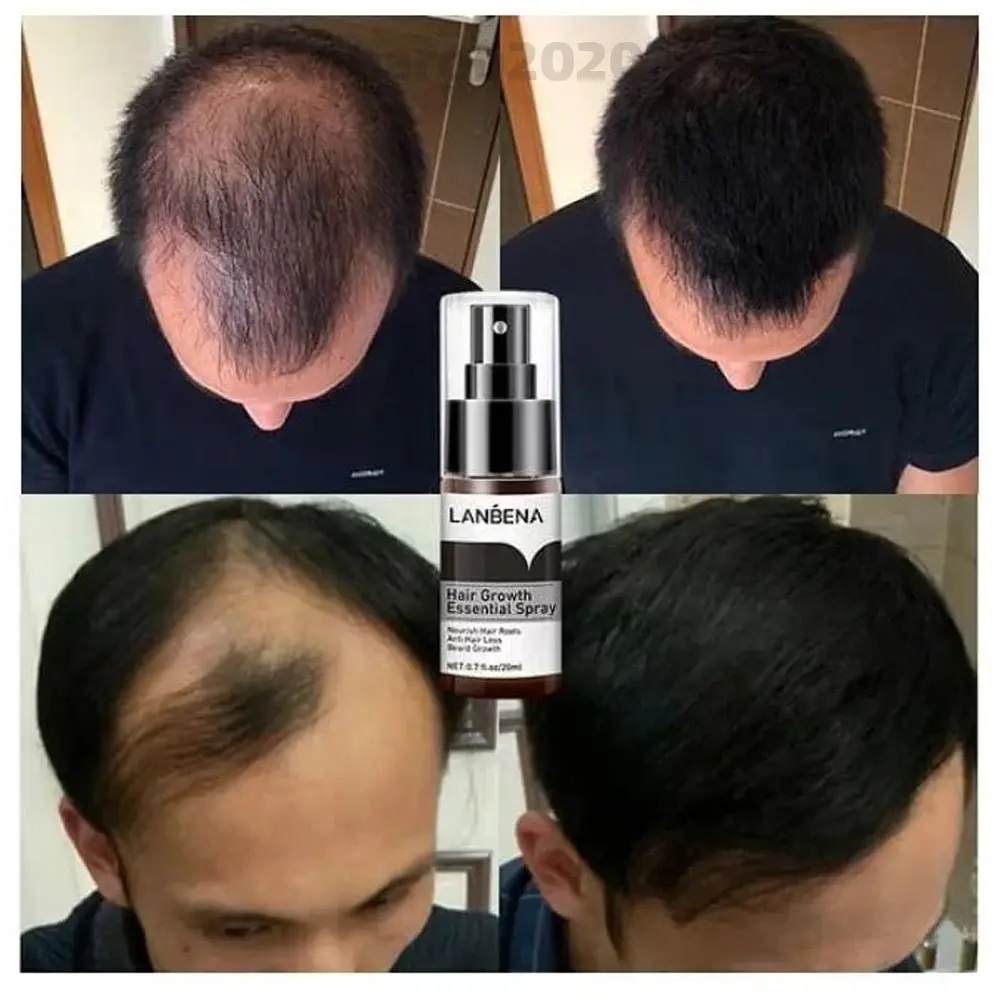 اسپری محرک رشد و ضدریزش مو لانبنا - Image 4